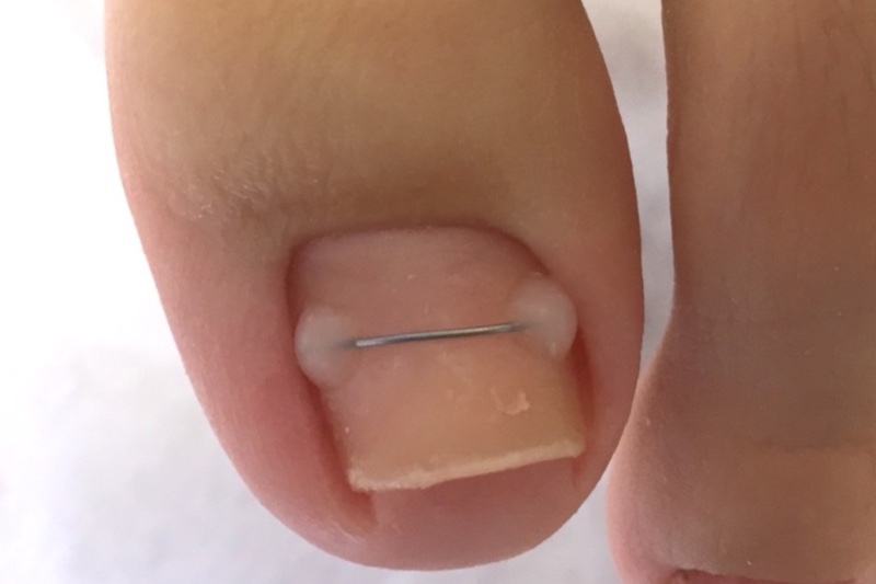 Титановая нить – безболезненный метод лечения вросшего ногтя